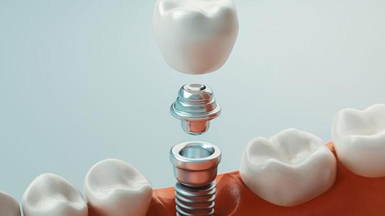 Her diş kaybı implant gerektirir Dişsiz kalmak çene kemiğini eritiyor