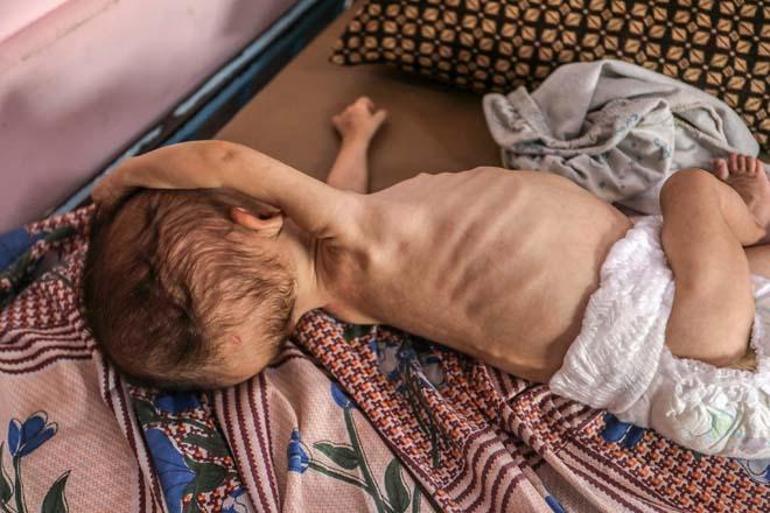 Gazze’de sessiz katliam: Bebekler açlıktan can veriyor