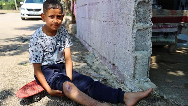 Kaykayla hayata tutunmuştu: Ayağındaki kemik yanlış kaynayan Serdal artık yürüyebiliyor