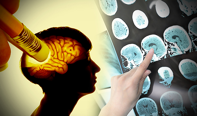 Araştırma: Bu meslekte çalışanlarda Alzheimer riski daha düşük!