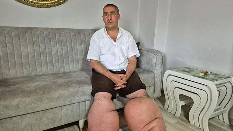 15 yıldır fil hastalığıyla mücadele ediyor: Eşim sadece rahat bir ayakkabı giysin